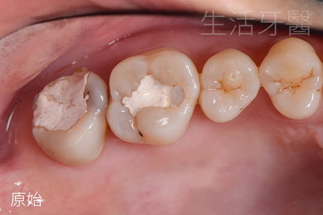 台中牙醫推薦|齒雕(陶瓷嵌體)- 其實,有時候你可以不必做假牙