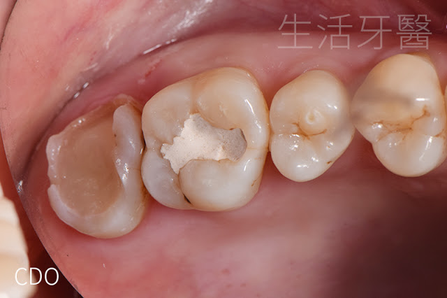 台中牙醫推薦|齒雕(陶瓷嵌體)- 其實,有時候你可以不必做假牙