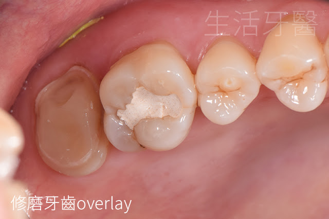 台中牙醫推薦|齒雕(陶瓷嵌體)- 其實,有時候你可以不必做假牙