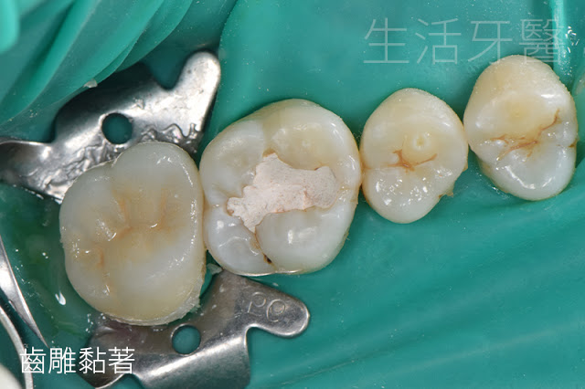 台中牙醫推薦|齒雕(陶瓷嵌體)- 其實,有時候你可以不必做假牙
