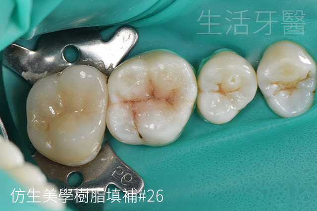 台中牙醫推薦|齒雕(陶瓷嵌體)- 其實,有時候你可以不必做假牙