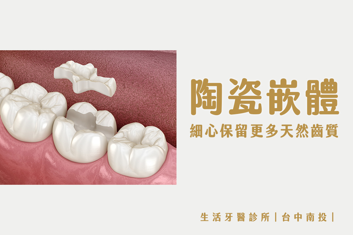 台中牙醫推薦｜齒雕（陶瓷嵌體）- 其實，有時候你可以不必做假牙