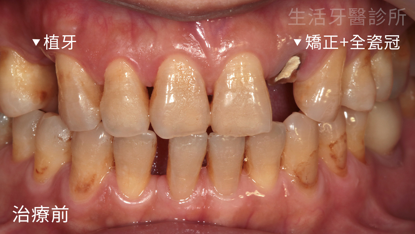 牙齒斷掉+牙齒斷一半+門牙斷裂