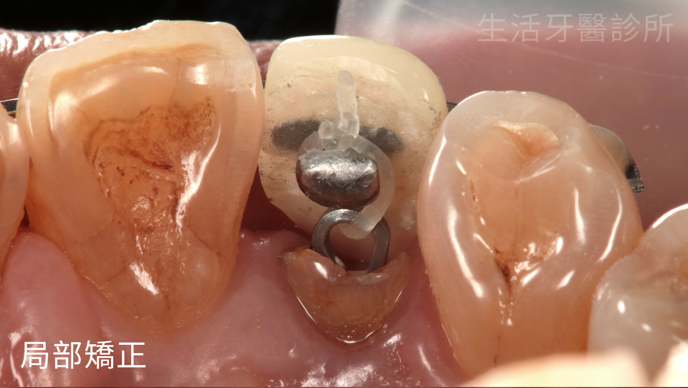 牙齒斷掉怎麼辦?矯正+全瓷冠假牙救回來,誰說一定要植牙