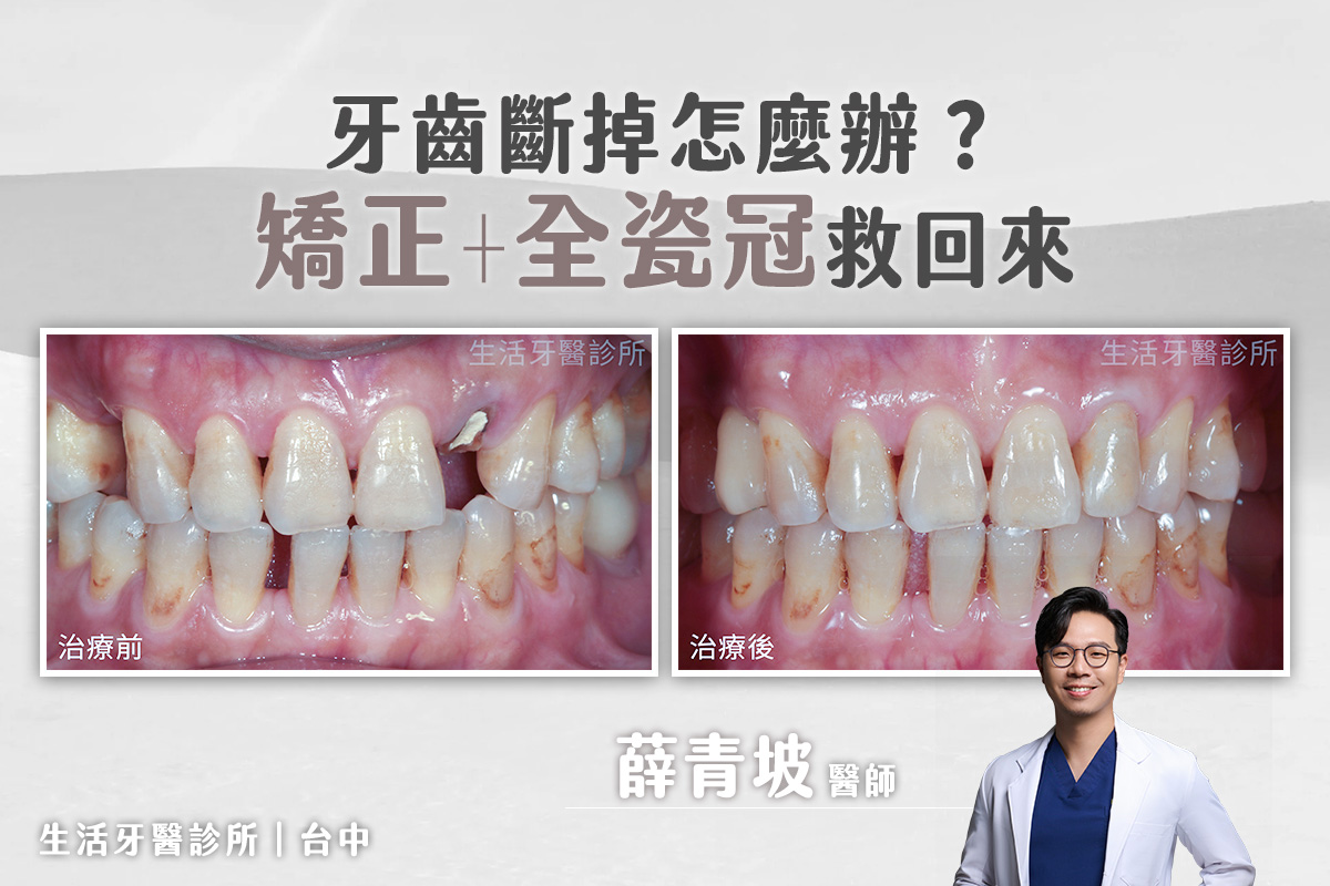 牙齒斷掉怎麼辦？矯正+全瓷冠假牙救回來，誰說一定要植牙