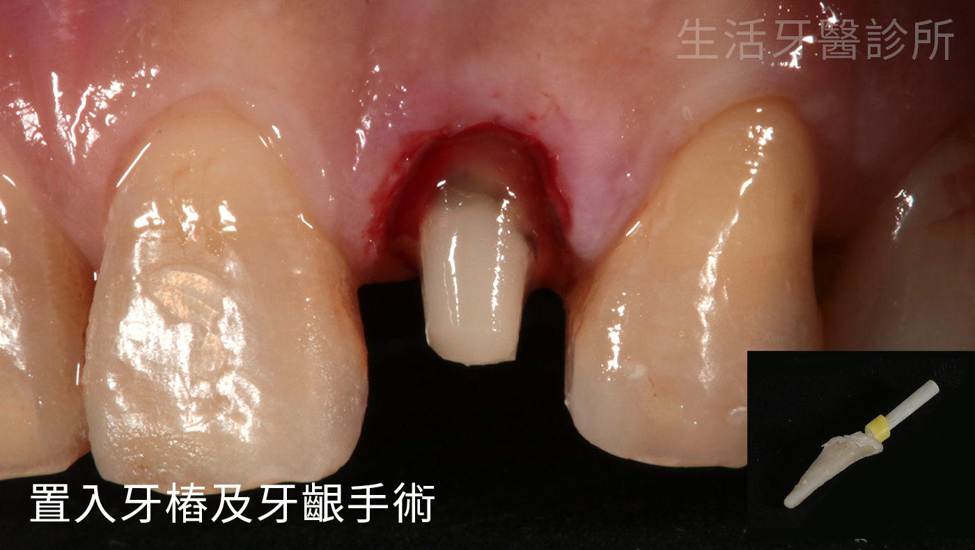 台中假牙牙醫推薦+台中牙醫推薦+全瓷冠假牙