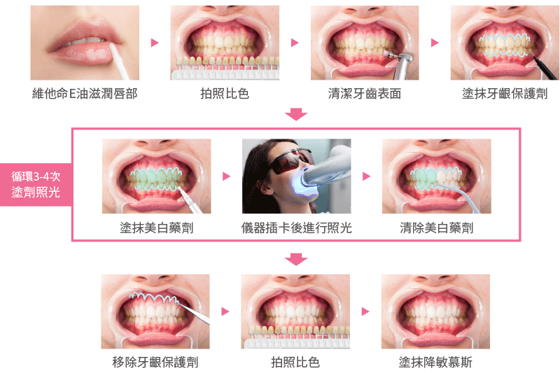 台中冷光美白推薦牙醫價錢13000