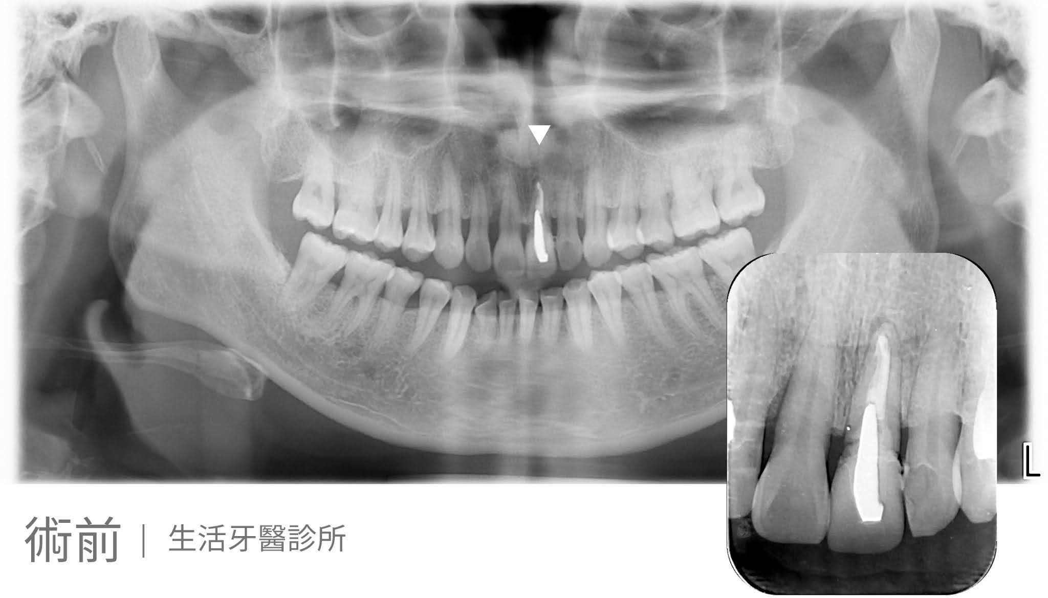 牙齒斷裂+台中植牙假牙牙醫推薦+牙根裂掉