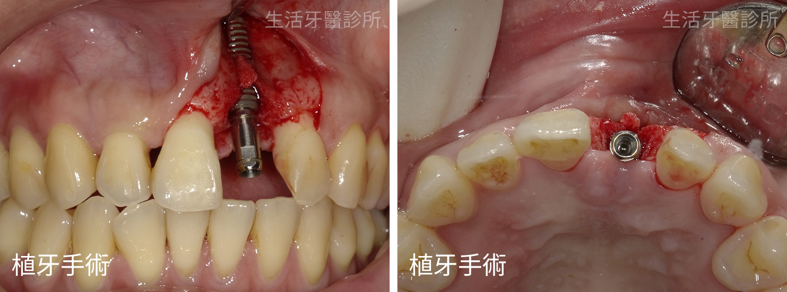 拔除斷裂的牙齒,植牙拾回美觀門面