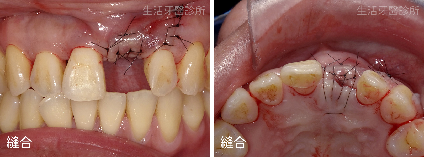 拔除斷裂的牙齒,植牙拾回美觀門面