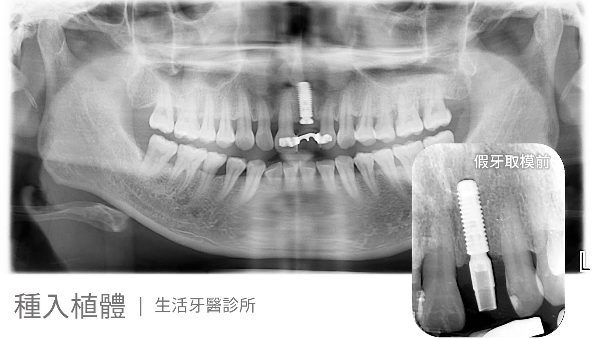 拔除斷裂的牙齒,植牙拾回美觀門面