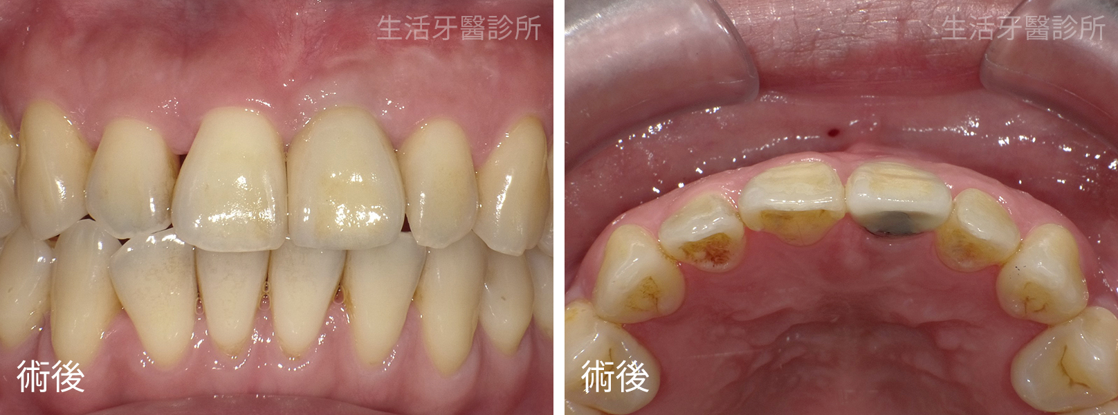 台中植牙牙醫推薦+門牙植牙+牙根牙齒斷裂