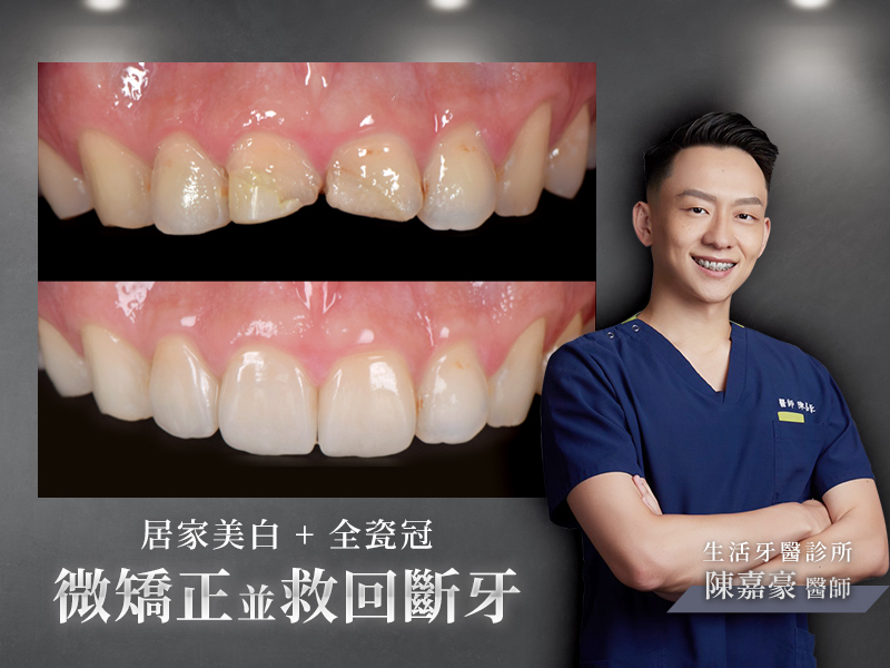 解決車禍斷牙+微矯正只需要全瓷冠