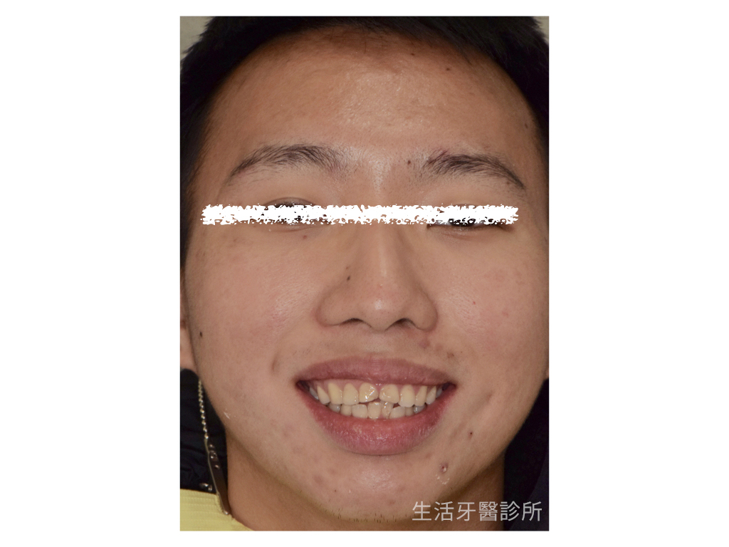 牙齒斷裂+台中植牙假牙牙醫推薦+牙根裂掉