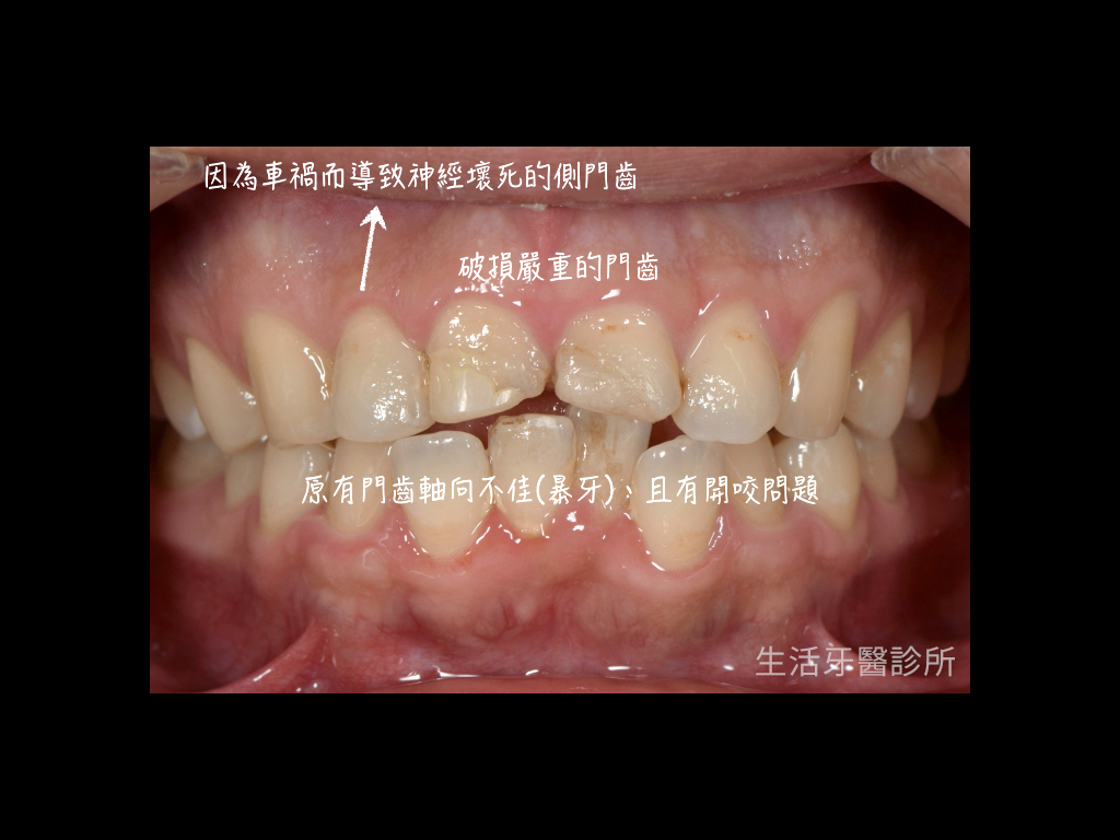 解決車禍斷牙+微矯正只需要全瓷冠