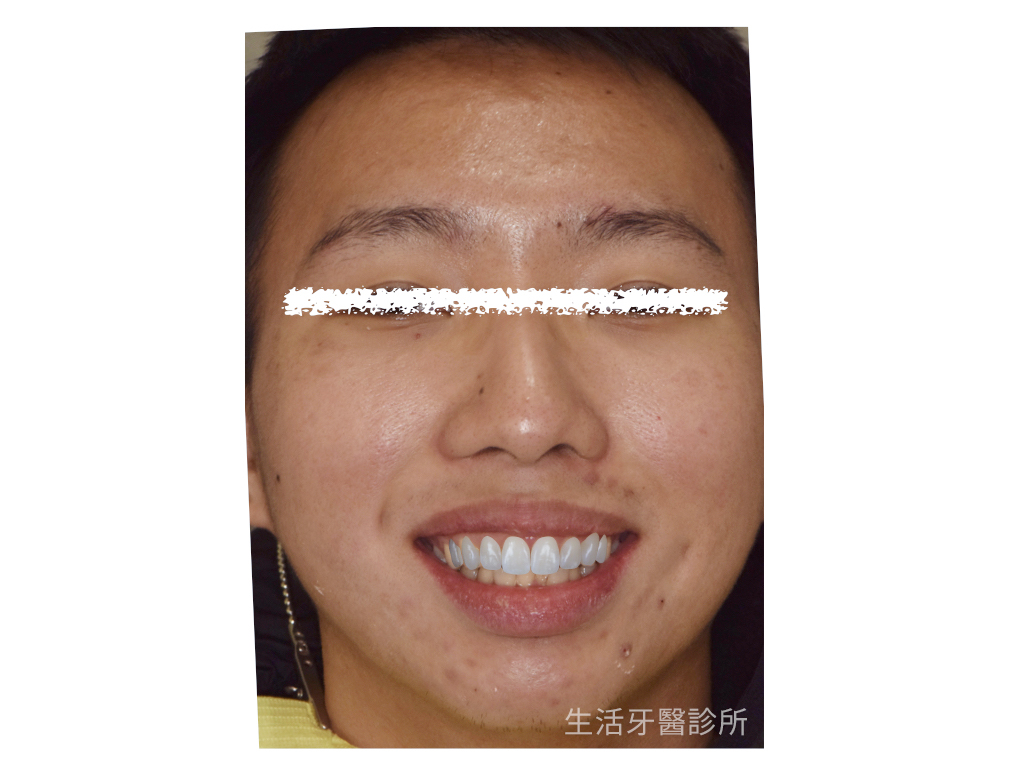 解決車禍斷牙+微矯正只需要全瓷冠