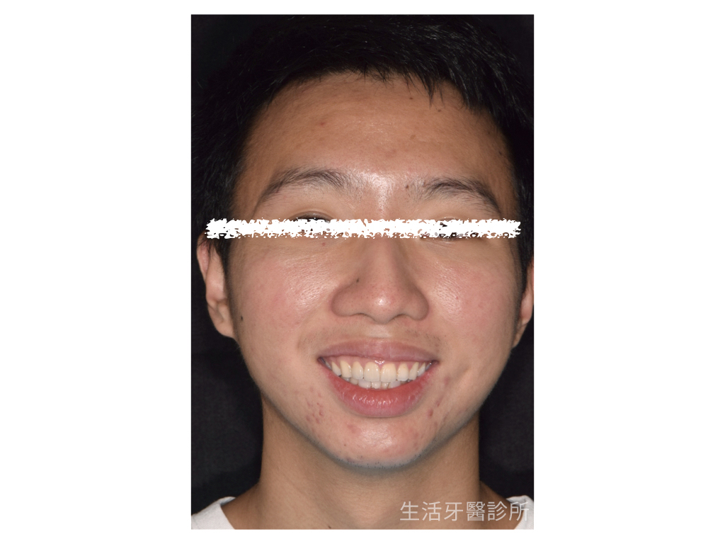 解決車禍斷牙+微矯正只需要全瓷冠
