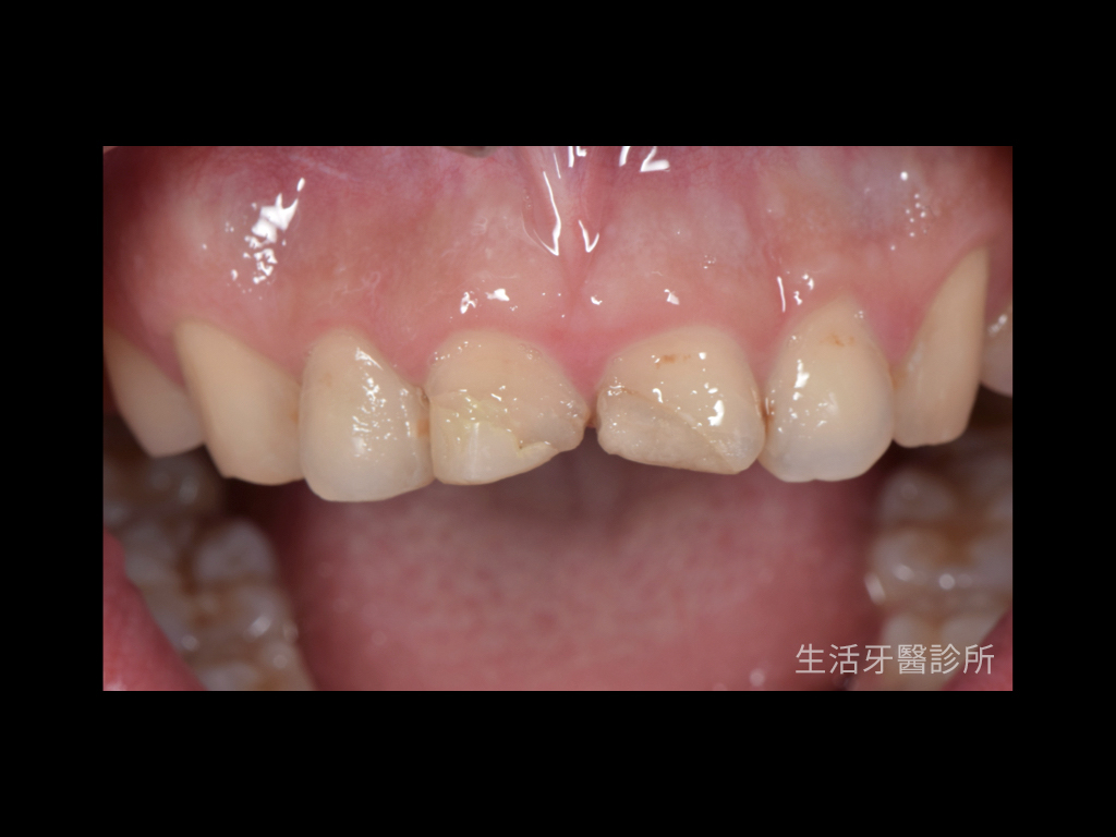 解決車禍斷牙+微矯正只需要全瓷冠
