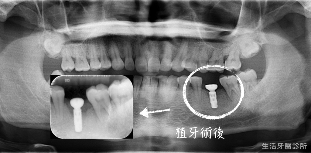 即拔即種植牙+補骨,迅速重建臼齒