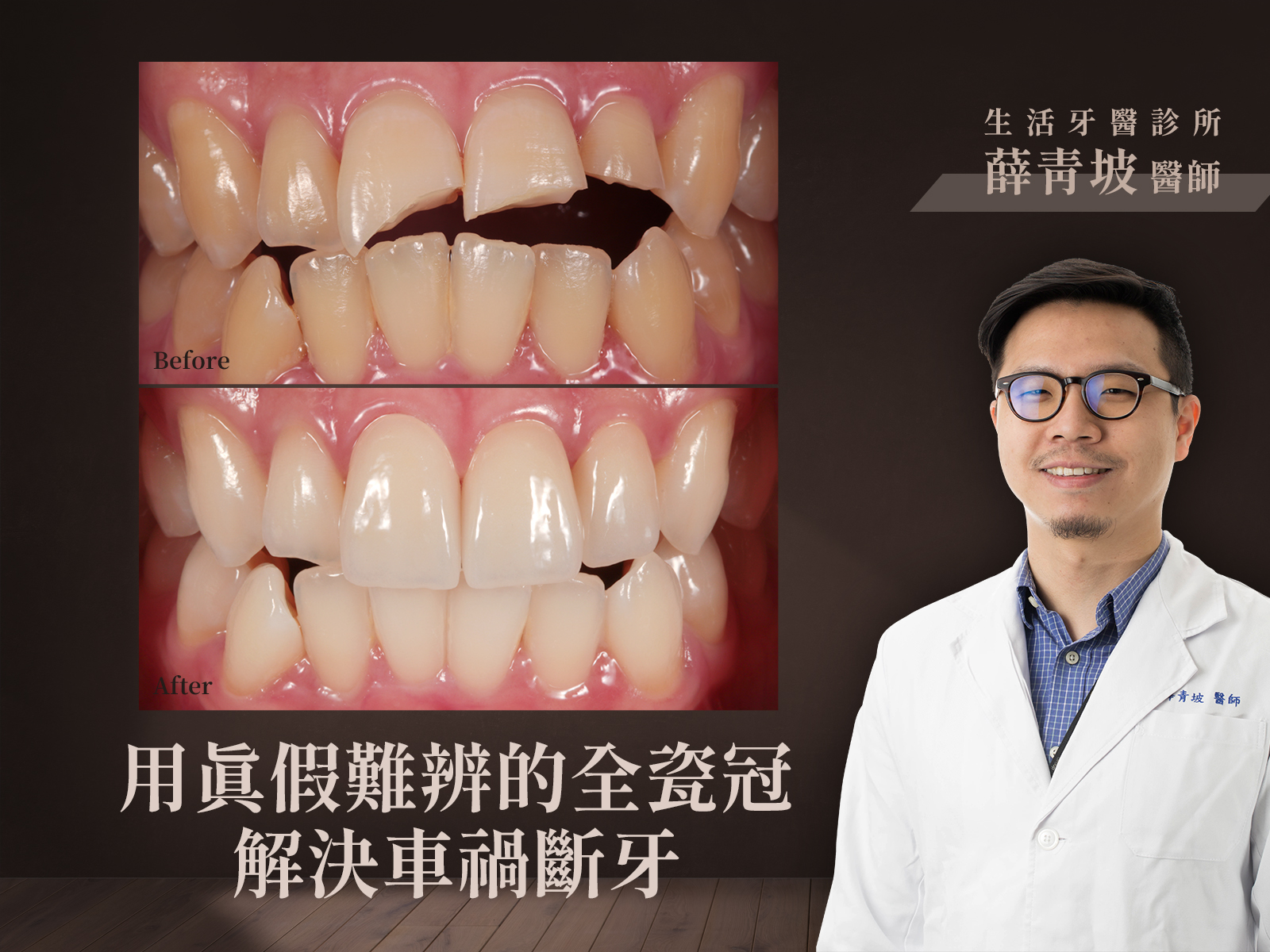 牙齒斷裂+台中假牙牙醫推薦+全瓷冠