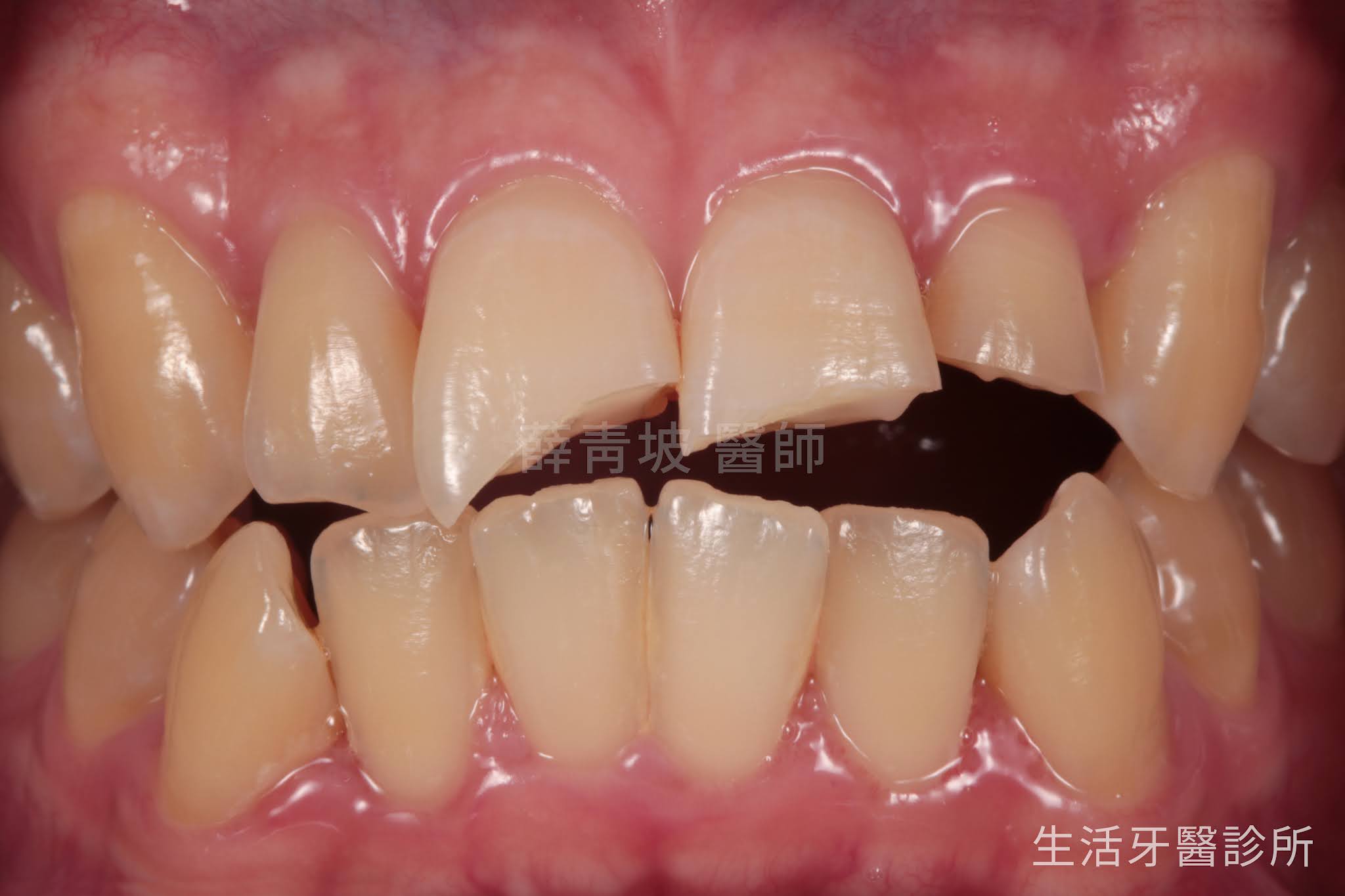 門牙斷掉+台中假牙套牙醫推薦+全瓷冠