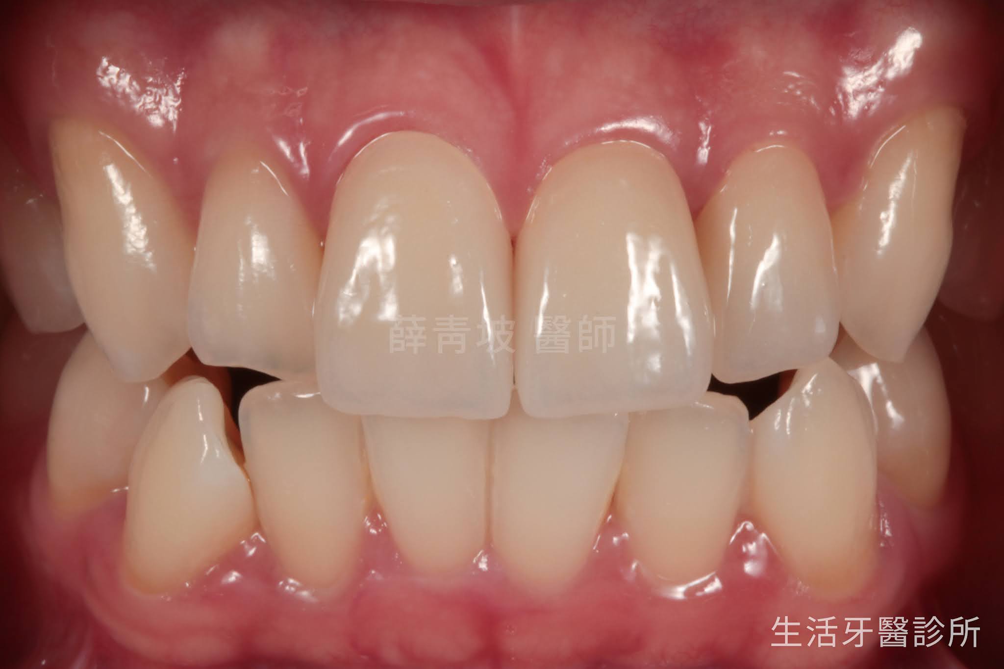 用真假難辨的全瓷冠,解決門牙車禍斷牙