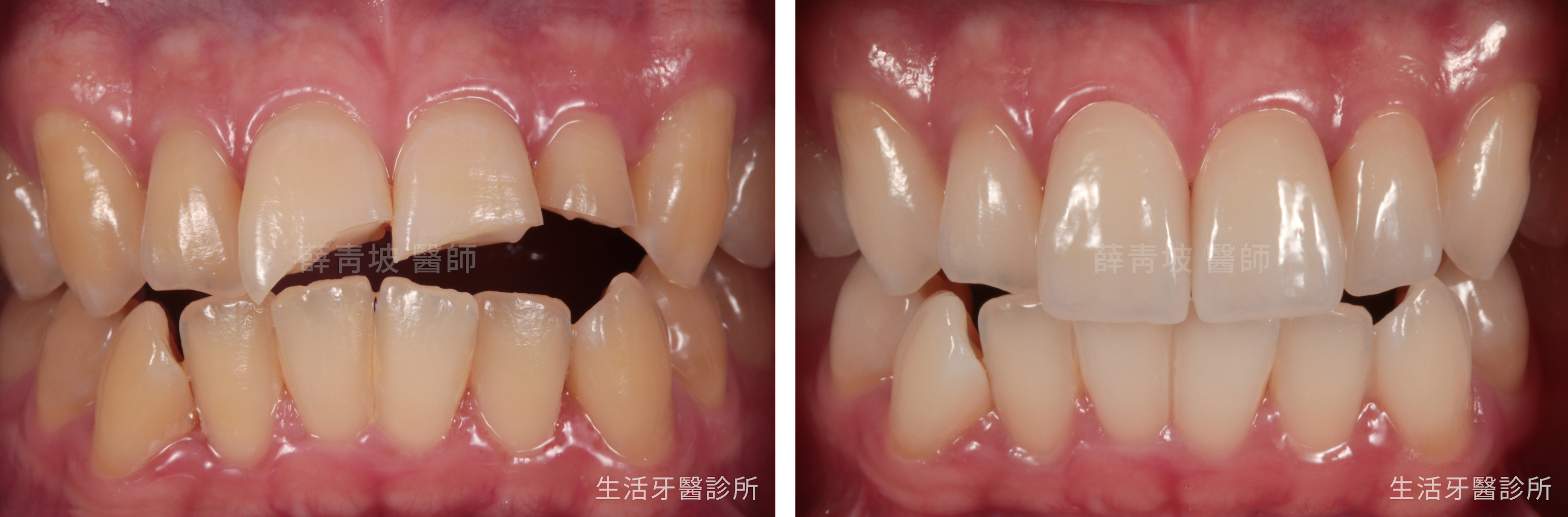 台中南屯假牙牙醫推薦+門牙假牙+台中全瓷冠牙醫
