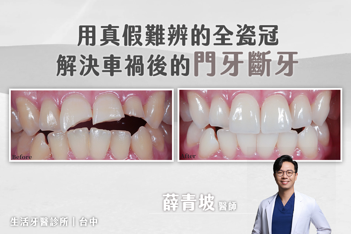 用真假難辨的全瓷冠，解決門牙車禍斷牙