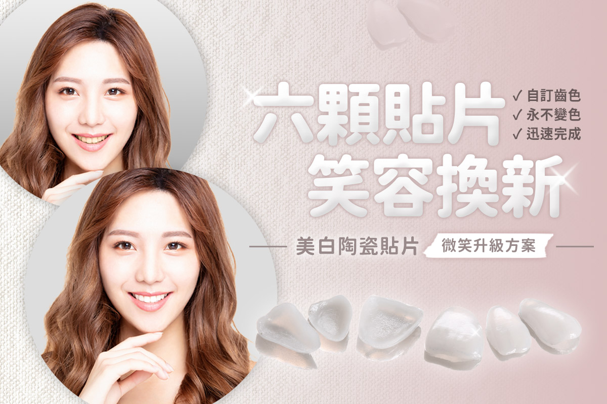 台中陶瓷貼片推薦｜六顆貼片 笑容換新，美白陶瓷貼片給你最閃耀的動人笑容