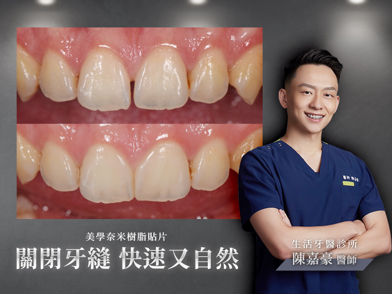 美學奈米樹脂貼片 輕鬆關閉牙縫(門牙牙縫太大)