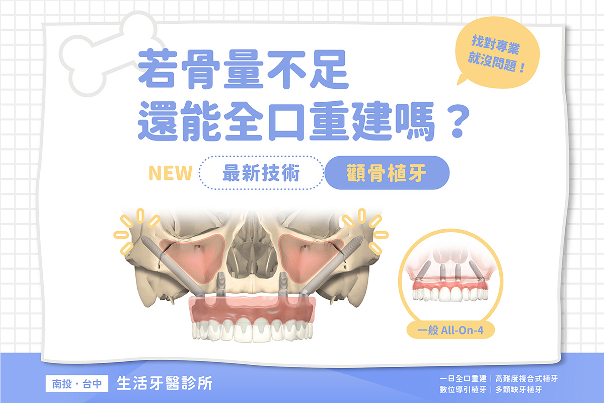 顴骨植牙—全口重建骨量不足的救星