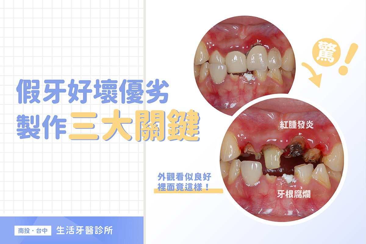 假牙品質好壞 3大製作關鍵