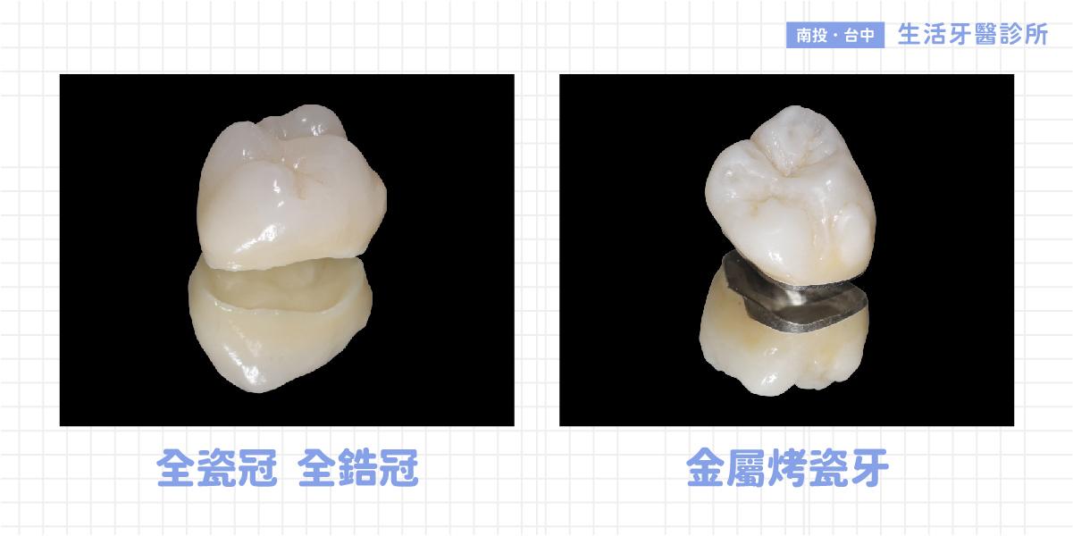 假牙品質好壞 3大製作關鍵