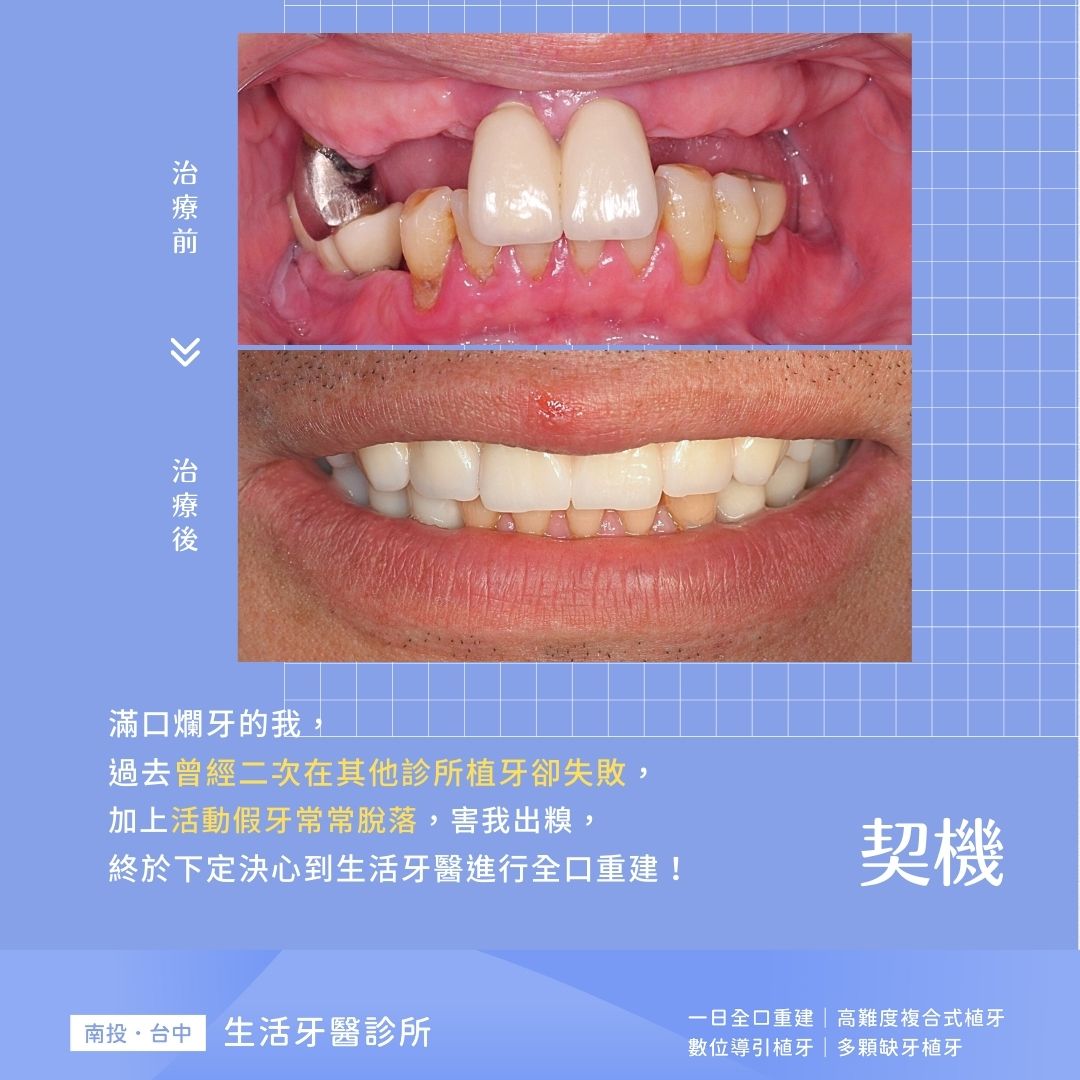 【All-On-4全口重建實際案例】自信健康人生,絕對值得投資