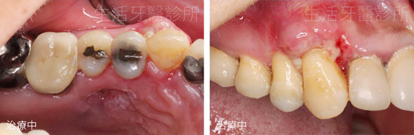 台中南投生活牙醫牙根覆蓋術治療過程與縫合情況