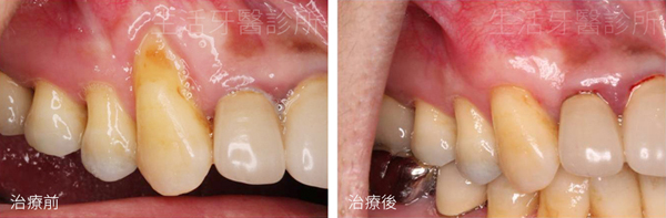 台中南投生活牙醫牙根覆蓋術治療前與術後三個月比較