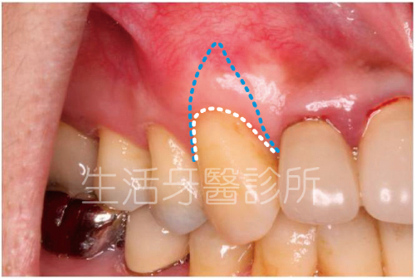 台中南投生活牙醫牙根覆蓋術治療前後牙齦高度比較