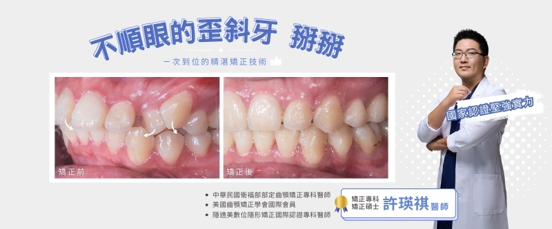 台中陶瓷貼片+台中瓷牙貼片