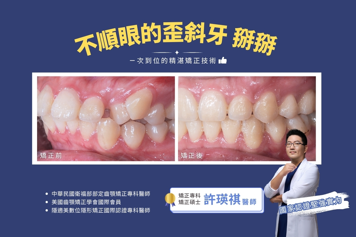 台中齒顎矯正專科-上顎前凸(暴牙)+齒列不整 實際案例照片@台中生活牙醫