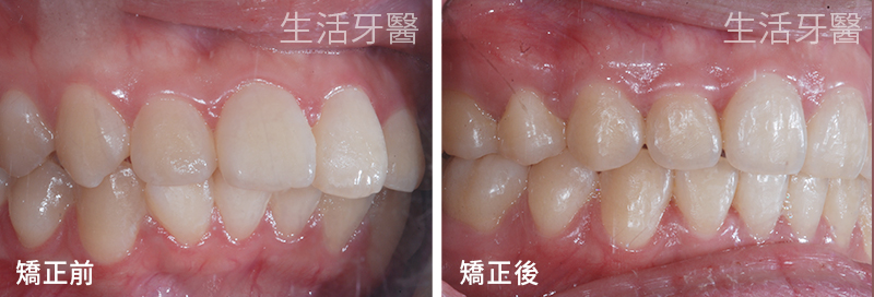 台中齒顎矯正專科-上顎前凸(暴牙)+齒列不整 實際案例照片@台中生活牙醫