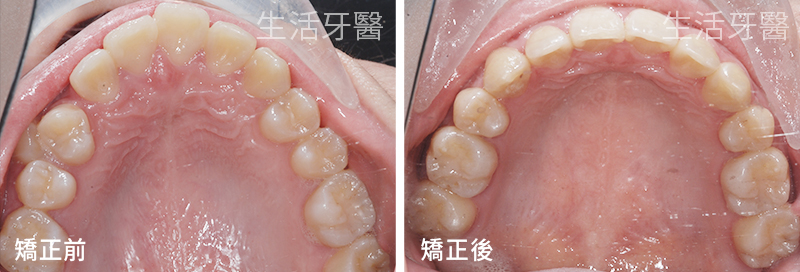 台中牙齒矯正推薦權威+台中生活牙醫評價心得