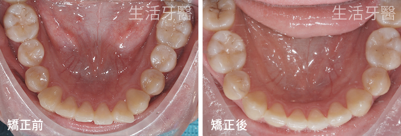 南屯矯正推薦+南屯牙醫診所
