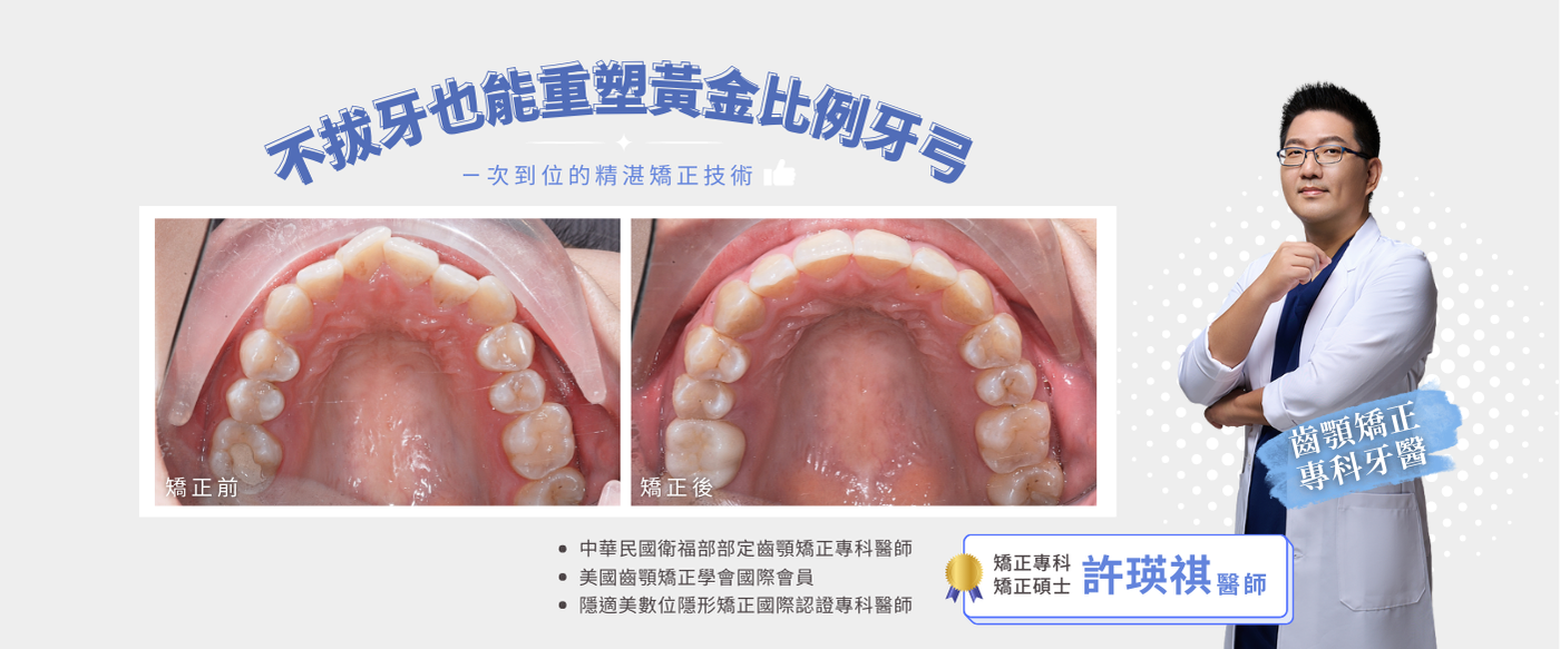 台中陶瓷貼片+台中瓷牙貼片