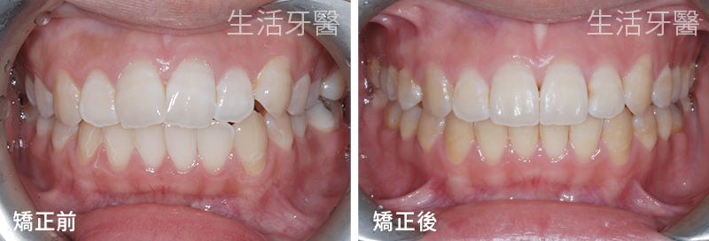 台中齒顎矯正專科|不拔牙矯正 齒列不整齊 實際案例分享|台中生活牙醫
