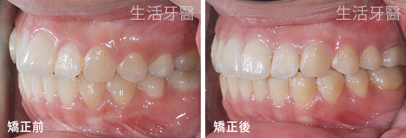台中齒顎矯正專科|不拔牙矯正 齒列不整齊 實際案例分享|台中生活牙醫