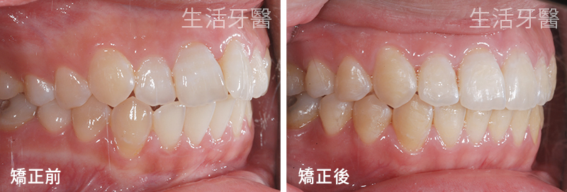 台中齒顎矯正專科|不拔牙矯正 齒列不整齊 實際案例分享|台中生活牙醫