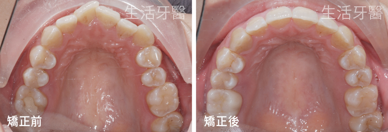 台中牙齒矯正推薦權威+台中生活牙醫評價心得