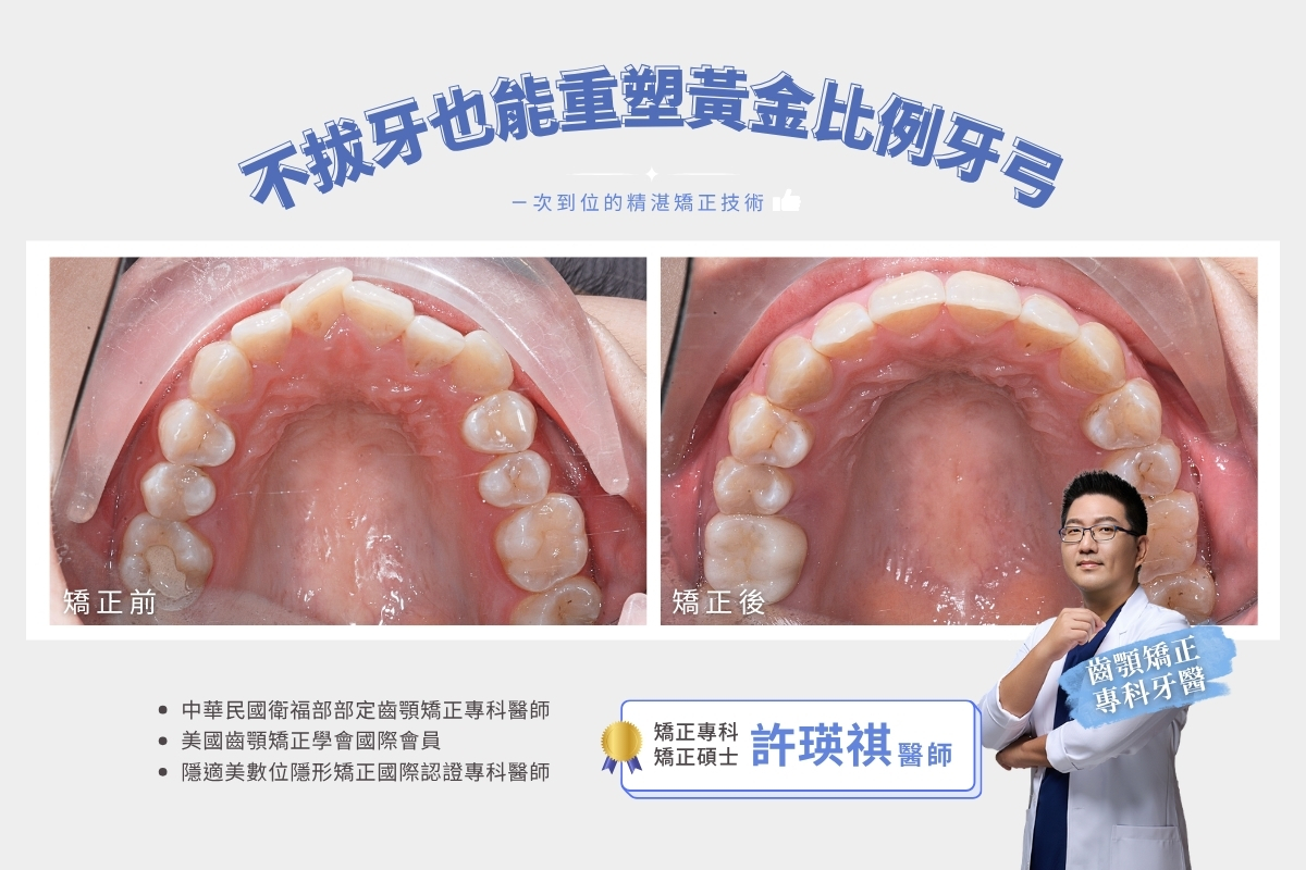 台中齒顎矯正專科｜不拔牙矯正 齒列不整齊 實際案例分享｜台中生活牙醫