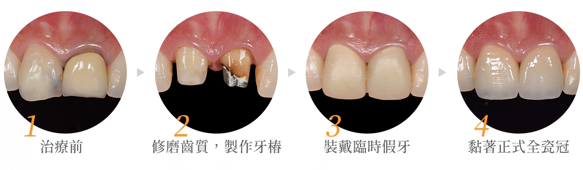 【全瓷冠是什麼?適應症、材質、流程一次解析】全瓷牙冠專業懶人包|台中牙醫推薦
