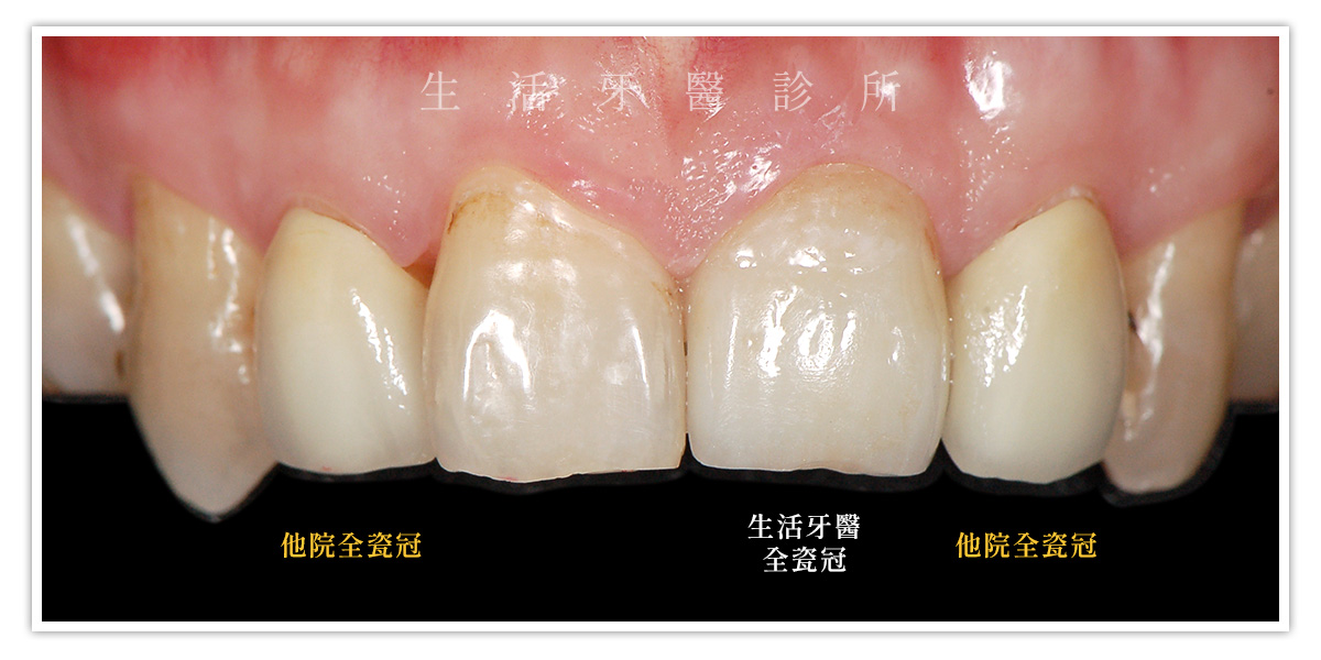 【全瓷冠是什麼?適應症、材質、流程一次解析】全瓷牙冠專業懶人包|台中牙醫推薦